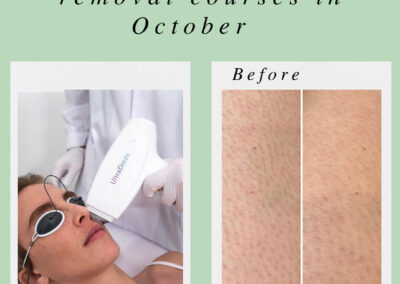 20% off ALL Laser hair removal courses in October