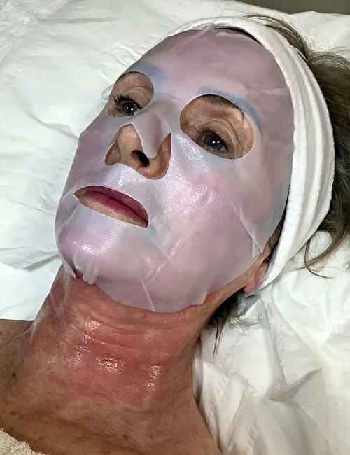 Microneedling at The Beauty Centre 001