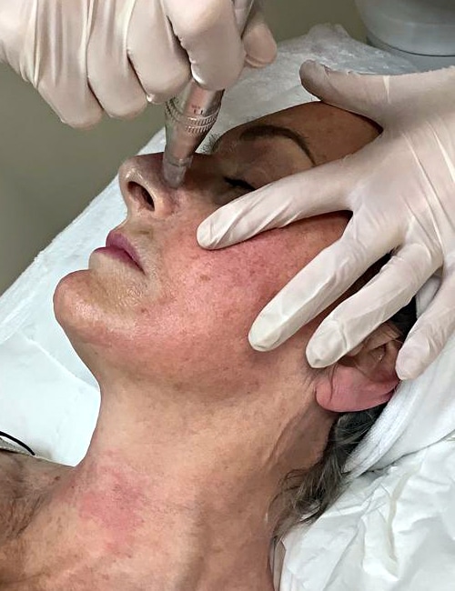 Microneedling at The Beauty Centre 002